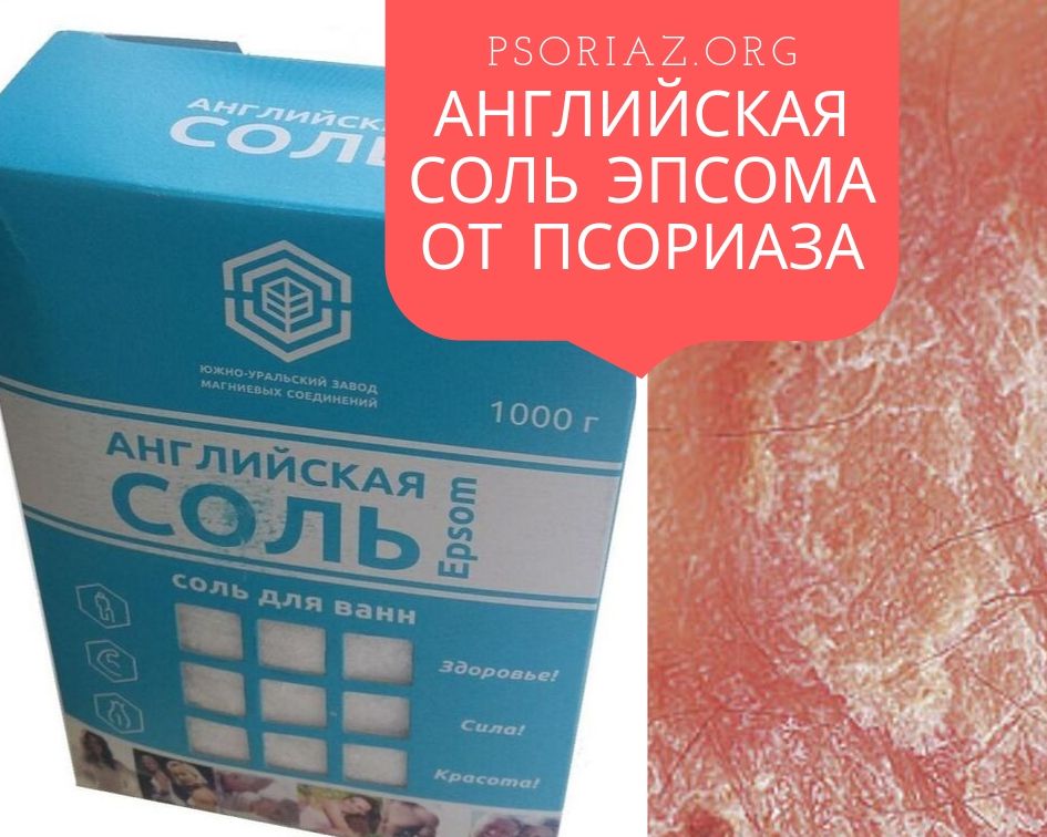 Английская соль Эпсома от псориаза