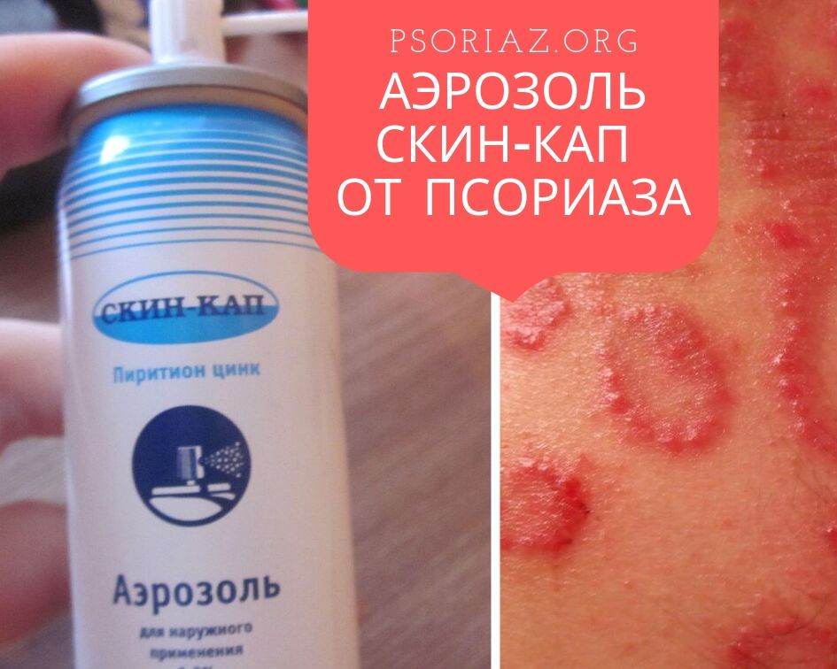 Аэрозоль Скин-Кап от псориаза