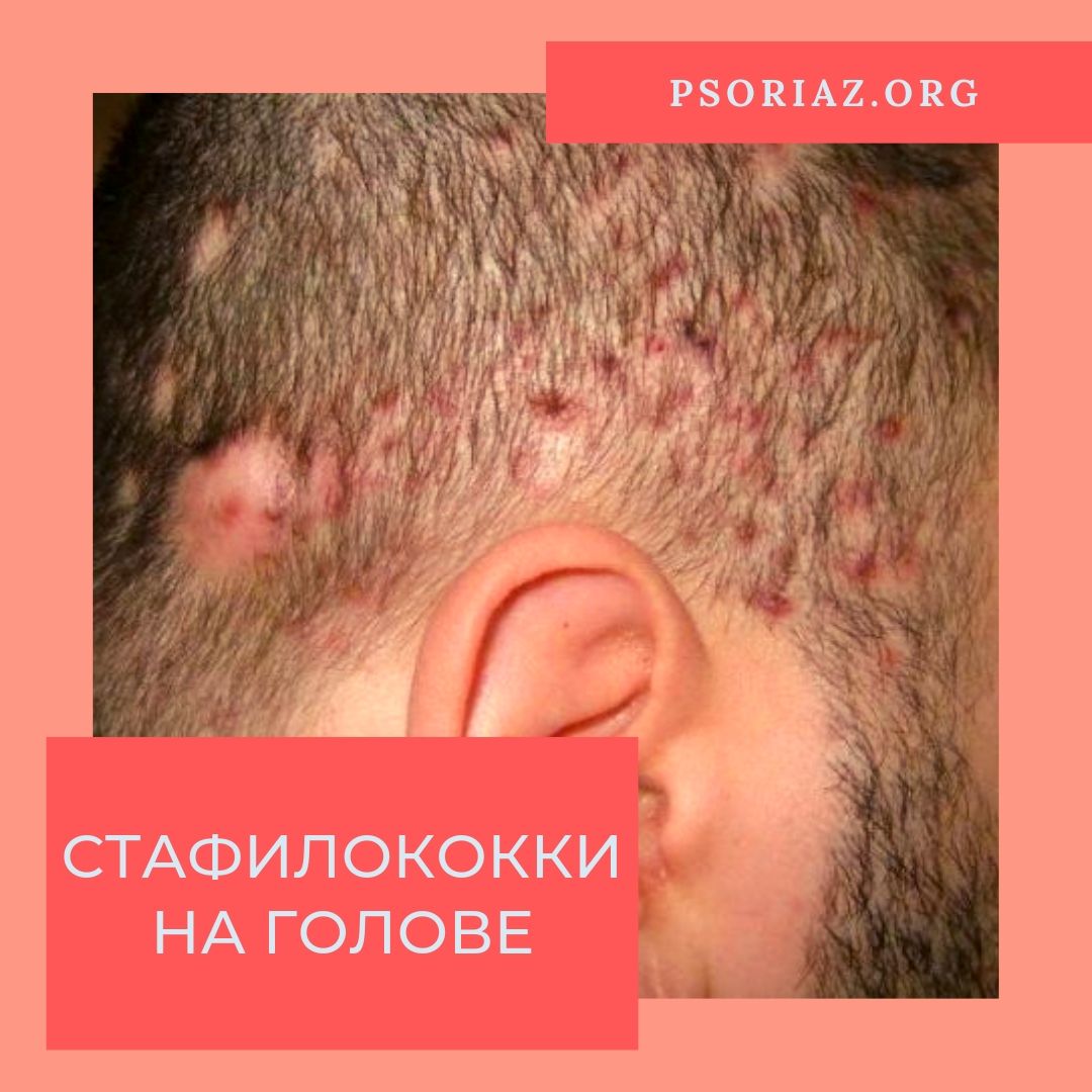 Cтафилококки на голове