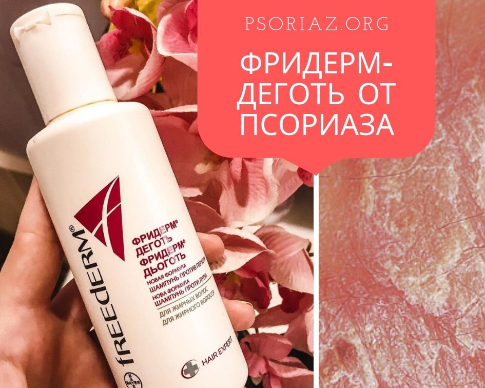 Фридерм-деготь от псориаза