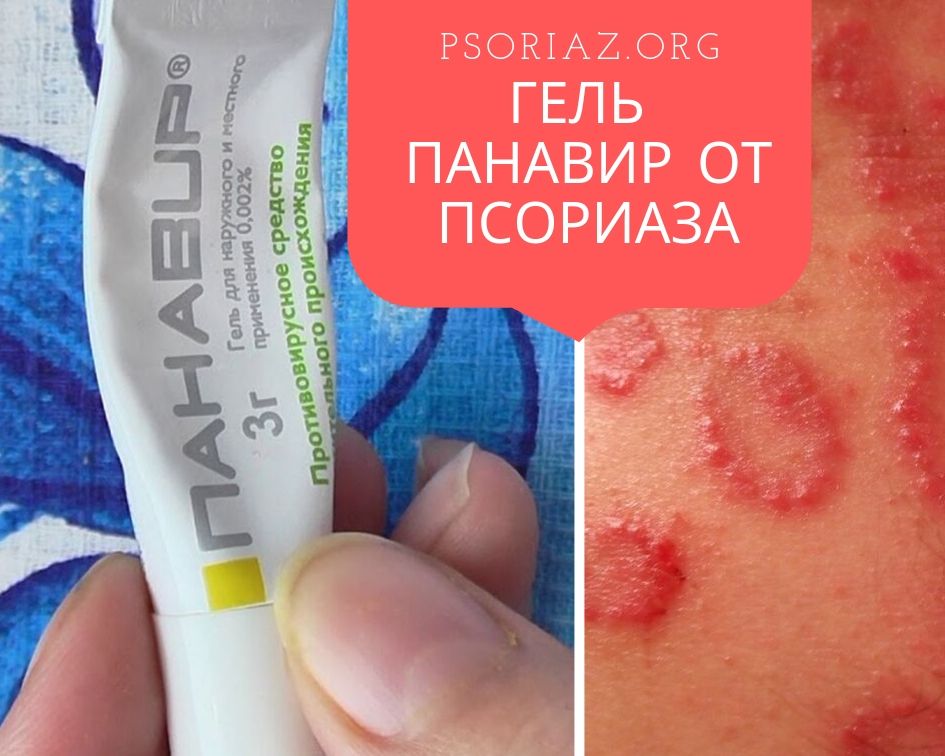 Гель Панавир от псориаза