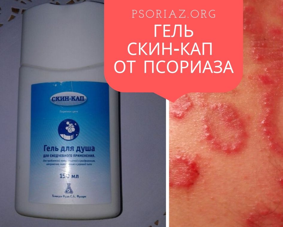 Гель Скин-Кап от псориаза