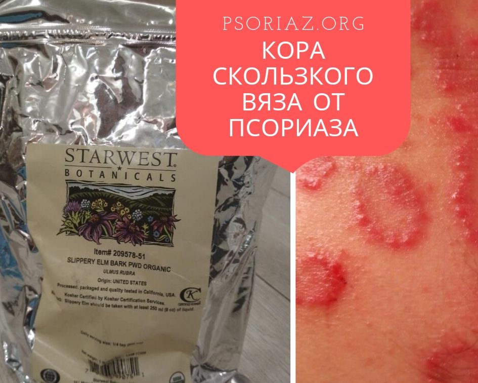 Кора скользкого вяза от псориаза