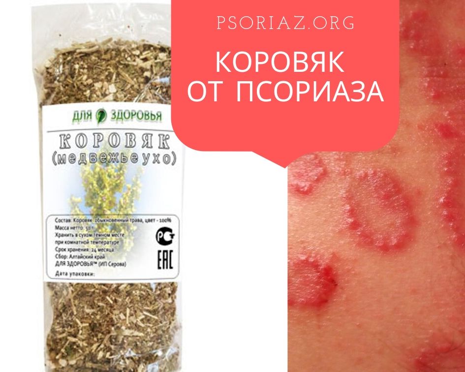 Коровяк (Медвежье ухо) от псориаза