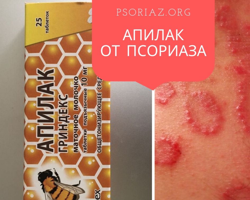 Маточное молочко Апилак от псориаза