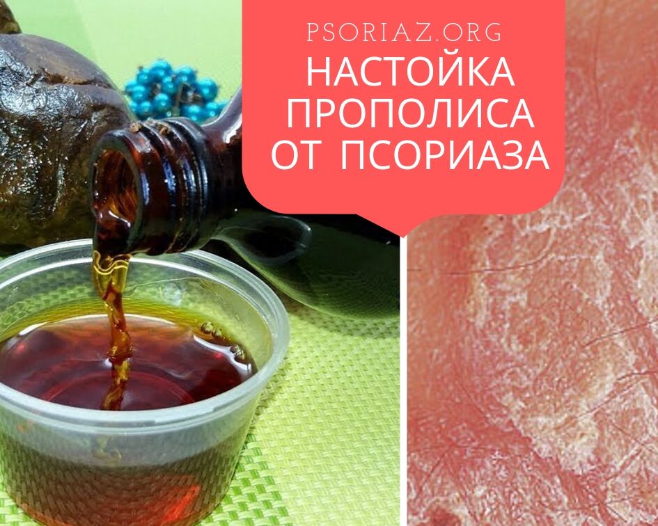 Настойка прополиса от псориаза