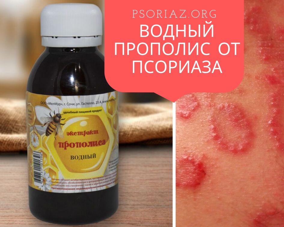 Водный прополис от псориаза
